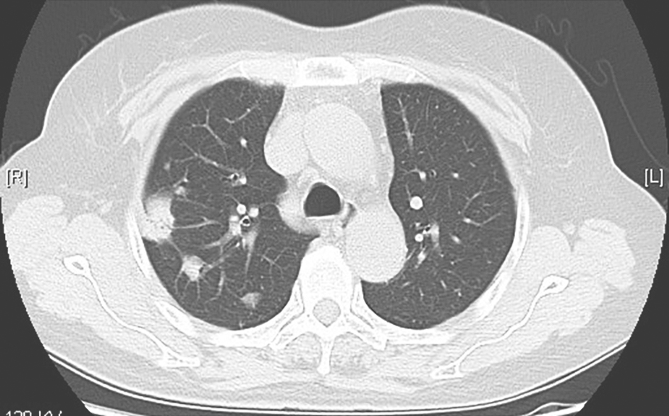 图4 肺隐球菌病胸部CT表现-2c82380019224a218b7267dc4ab6b9f9.jpg